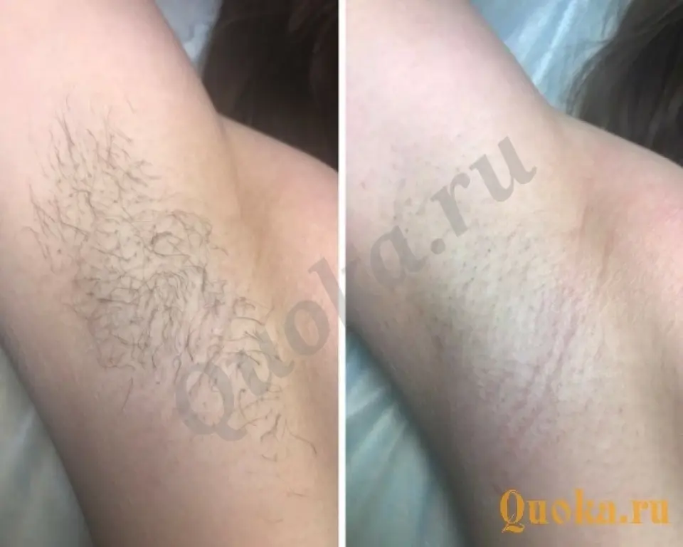 Шугаринг депиляция воском! Шугаринг депиляция воском!